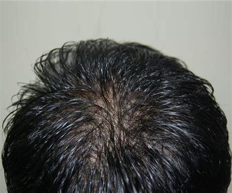 non surgical hair replacement in singapore