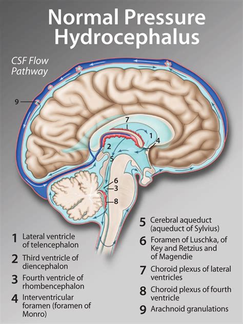 normal pressure hydrocephalus from diagnosis to treatment Doc