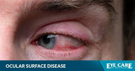 ocular surface disease ocular surface disease PDF