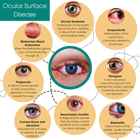 ocular surface disease ocular surface disease PDF