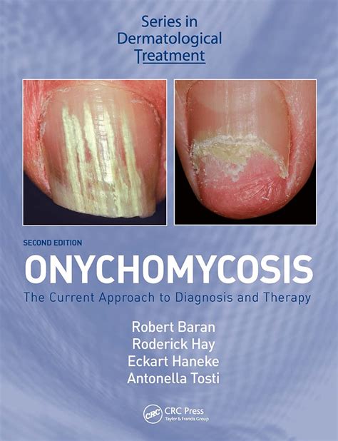 onychomycosis the current approach to diagnosis and therapy PDF