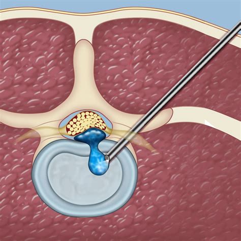 operation for slipped disc in back