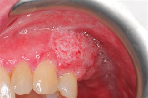 oral cancer lump on gum