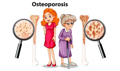 osteoporosis y menopausia osteoporosis y menopausia Epub