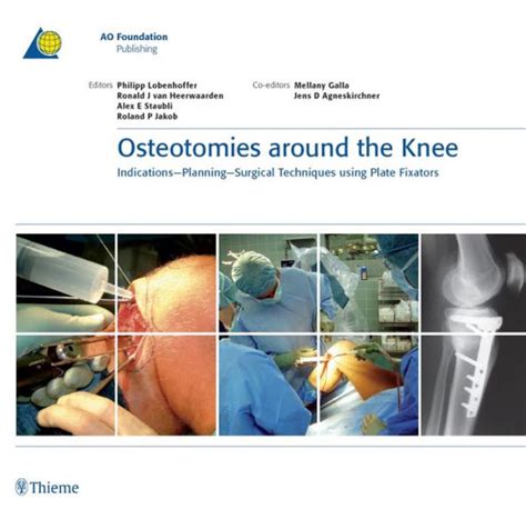 osteotomies around the knee indications planning surgical techniques using plate fixators Ebook Kindle Editon