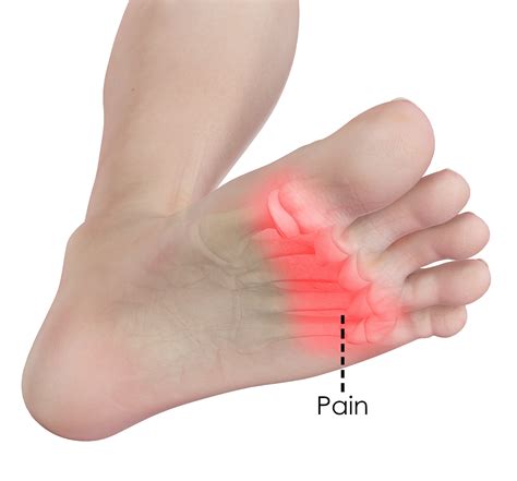 pain in sole of foot when walking