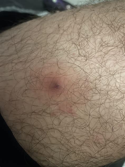 painful bump on inside of thigh