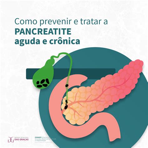 pancreatite aguda pode matar