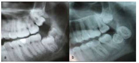 parietal supernumerary molar