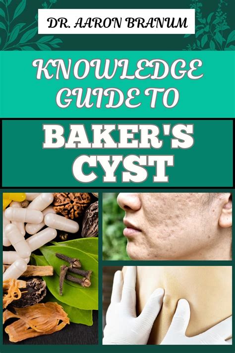 pedunculated cyst manual guide PDF