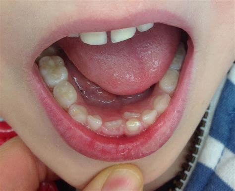 permanent tooth growing in front of baby tooth