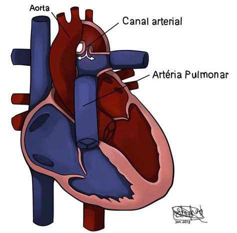 persistencia do canal arterial