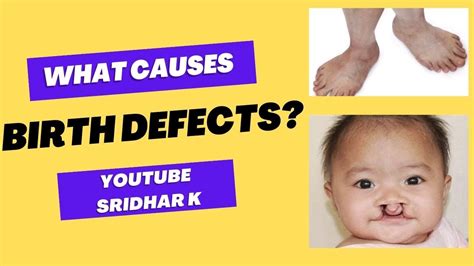 Birthdefect #8
