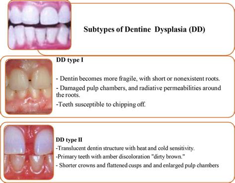 Dentine #2