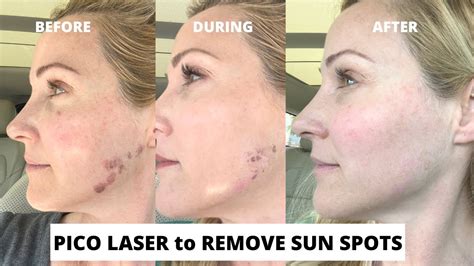 pico laser before and after 1 treatment