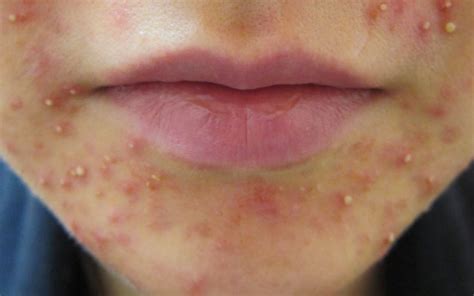 pimple breakout around mouth