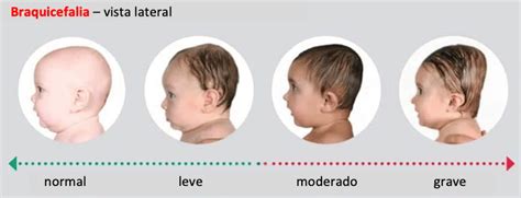 plagiocefalia moderada