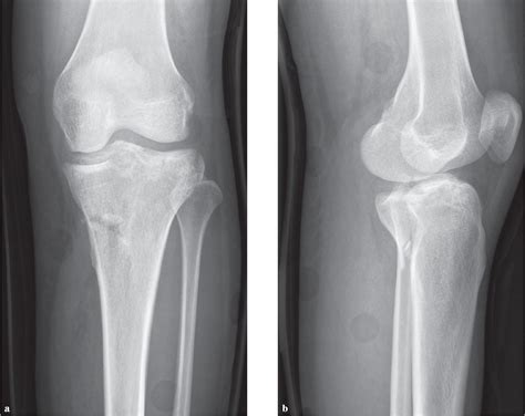 plato tibial