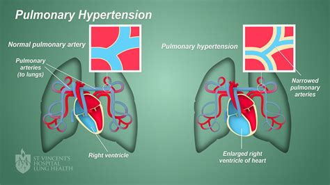 primary pulmonary hypertension lung biology in health and disease Epub
