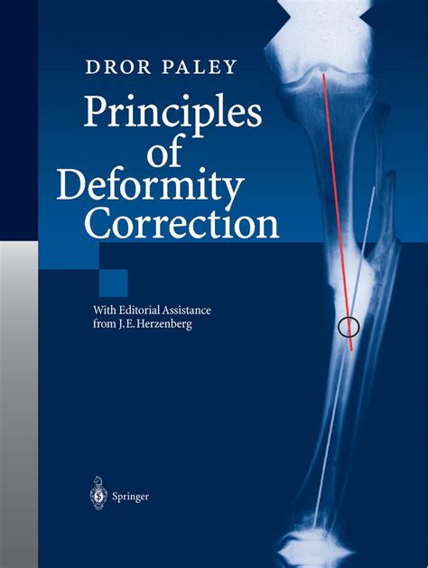 principles of deformity correction Ebook PDF