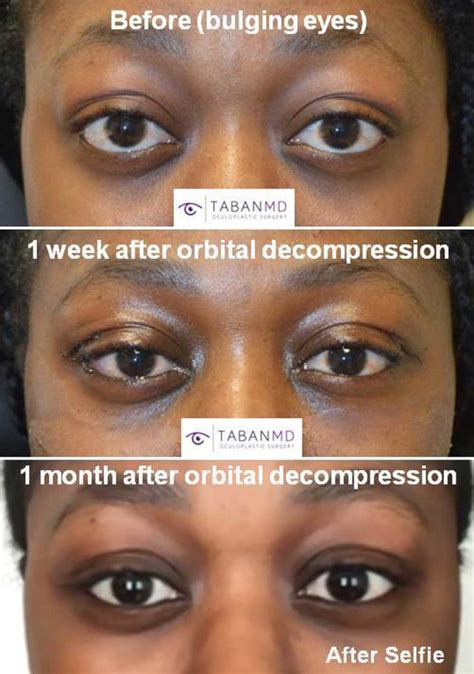 prominent eyes vs bulging eyes