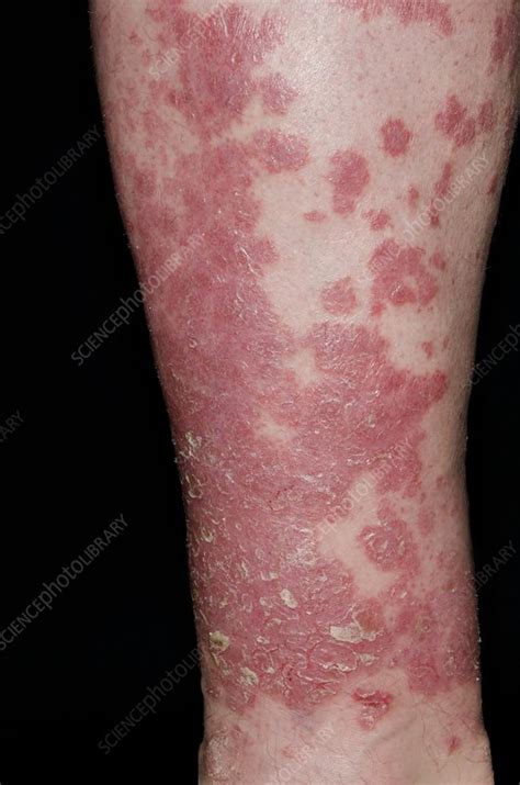 psoriasis images on legs