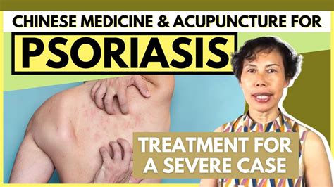 psoriasis in chinese