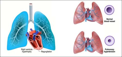 qqhpc-mdcvd: A Comprehensive Guide to Understanding and Managing This Condition