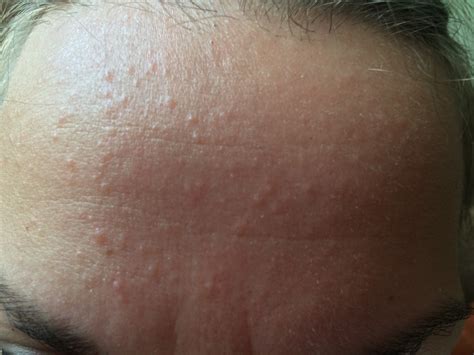 raised bumps on forehead