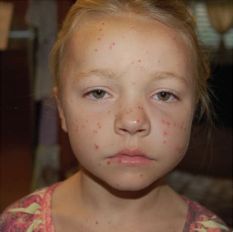 rashes on face and body after fever