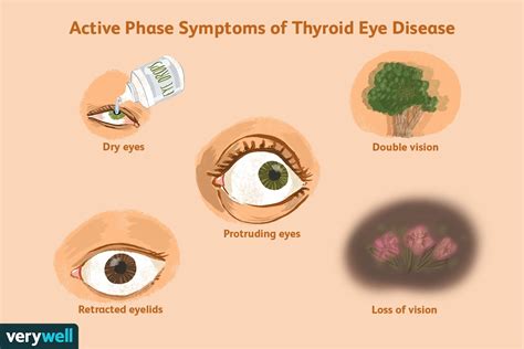 read download thyroid eye disease Kindle Editon