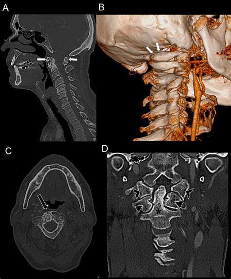 reconstruction of upper cervical spine and craniovertebral junction Reader