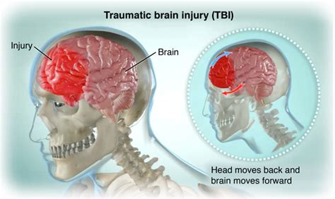 rehabilitation of the adult and child with traumatic brain injury Kindle Editon