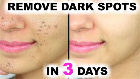 remove pimple marks and dark spots