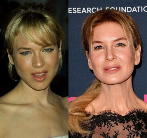 renee zellweger plastic surgery