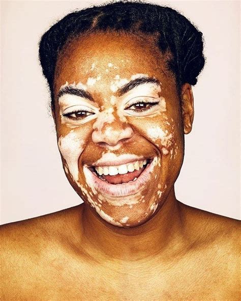 restless soul endless hope living with vitiligo PDF