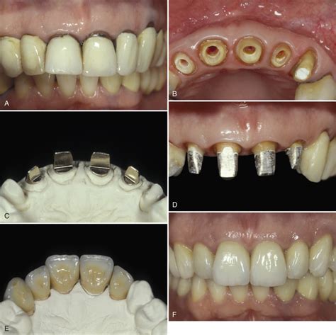 restoration of the endodontically treated tooth Kindle Editon