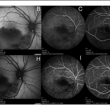 retinal angiography and optical coherence tomography Reader