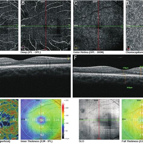 retinal angiography and optical coherence tomography Reader