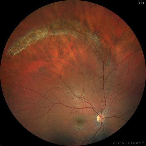 retinal degenerations retinal degenerations PDF