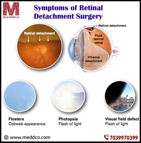 retinal detachment repair pdf Epub