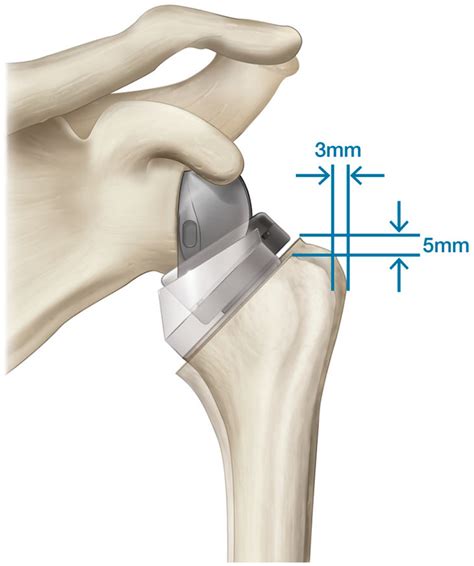 reverse shoulder arthroplasty clinical techniques PDF