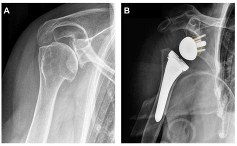 reverse shoulder arthroplasty clinical techniques PDF