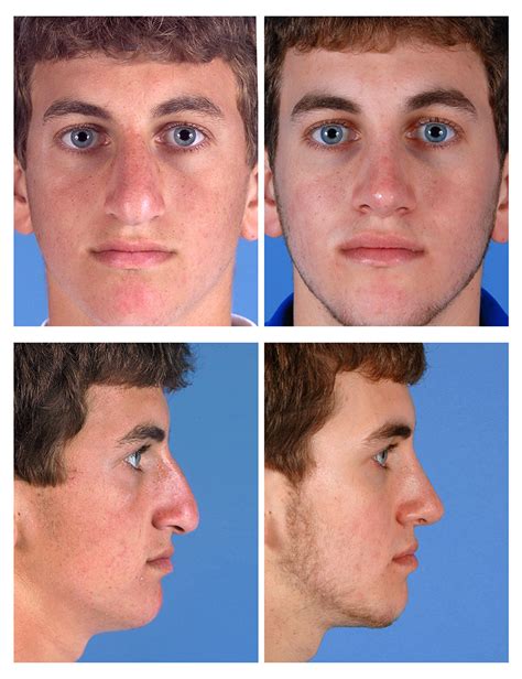 rhinoplasty before and after male