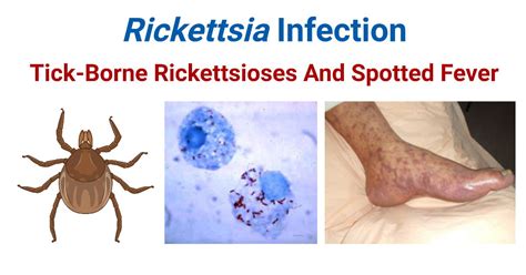 rickettsial diseases rickettsial diseases Epub