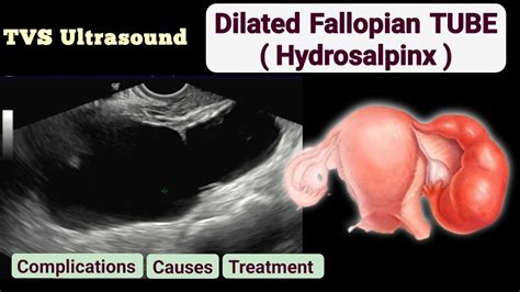 right hydrosalpinx manual guide Epub