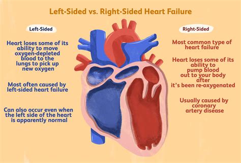 right sided versus left sided heart failure