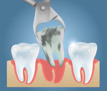 rotten tooth extraction cost