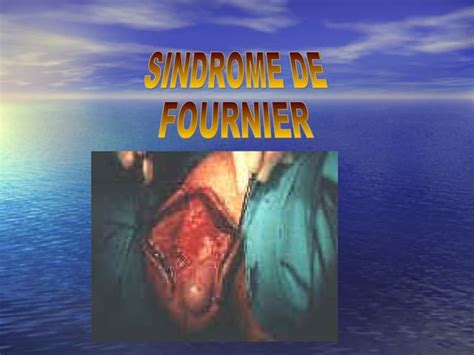 síndrome de fournier