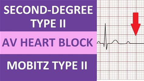 second degree type two heart block